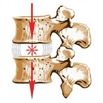 Das Säulengerät und die Ursachen von Osteochondrose