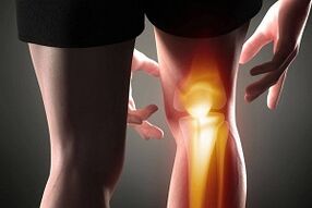 Zerstörung des Kniegelenks als Folge einer Arthrose.