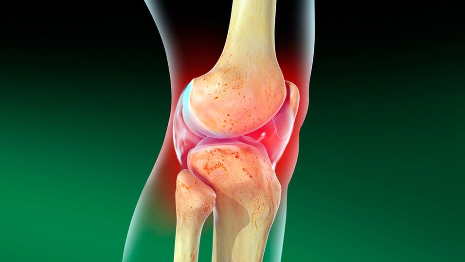 Arthrose des Kniegelenks.