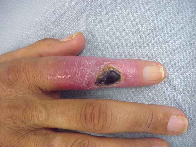 Osteomyelitis als Ursache für Schmerzen in den Fingergelenken