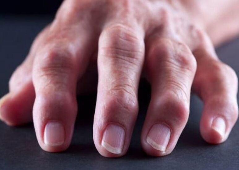 rheumatoide Arthritis als Ursache für Schmerzen in den Fingergelenken