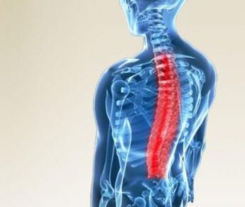 Rückenmarksverletzung bei Osteochondrose