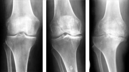 3 Stadien der Arthrose des Kniegelenks. 