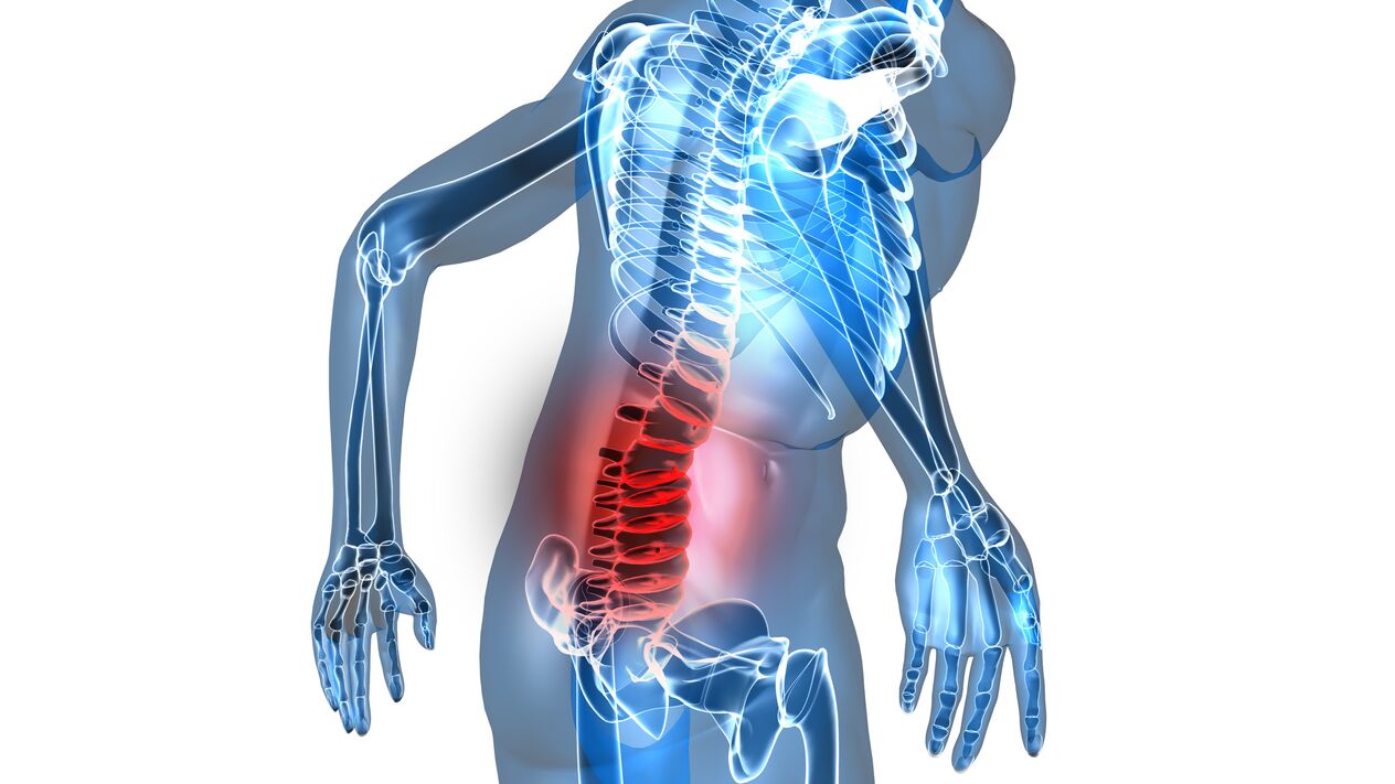 Osteochondrose der Lendenwirbelsäule